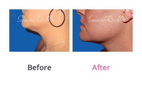 Liposuction-img-23