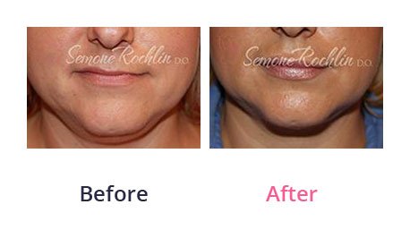 Liposuction-img-3