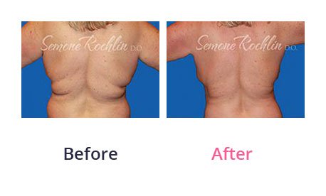 Liposuction-img-4