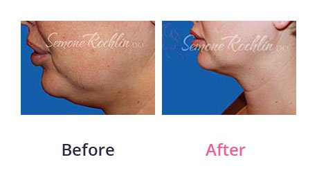 Liposuction-img-5