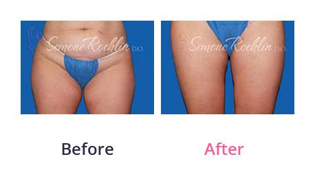 Liposuction-img-6