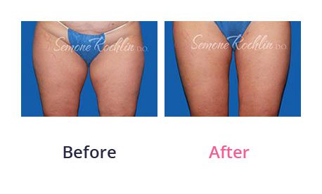 Liposuction-img-7