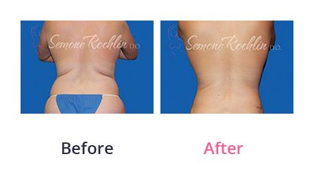 Liposuction-img-8