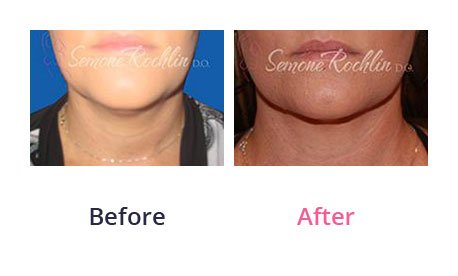 Liposuction-img-9