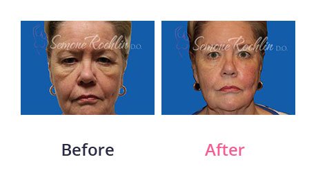 Liquid-Facelift-img-1