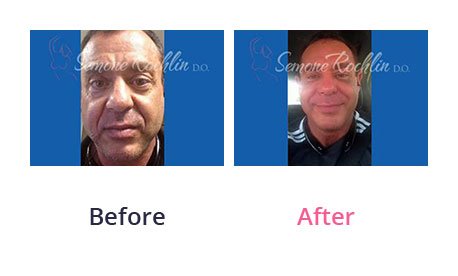Liquid-Facelift-img-2
