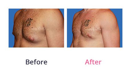 Male-Breasts-img-1