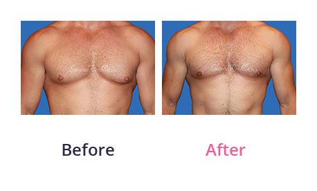 Male-Breasts-img-3
