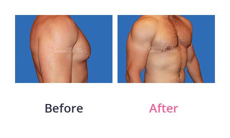 Male-Breasts-img-6