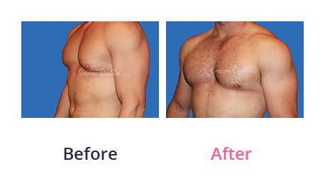 Male-Breasts-img-7