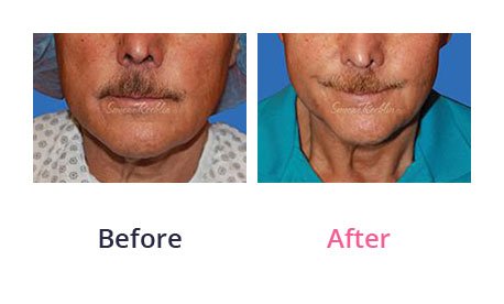 Mini-Facelift-img-1