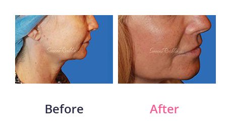 Mini-Facelift-img-10