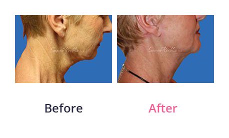Mini-Facelift-img-11
