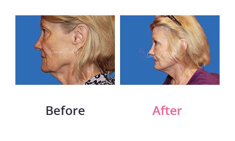 Mini-Facelift-img-4