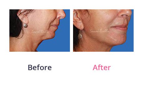 Mini-Facelift-img-6