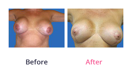 Mommy Makeover img (1)