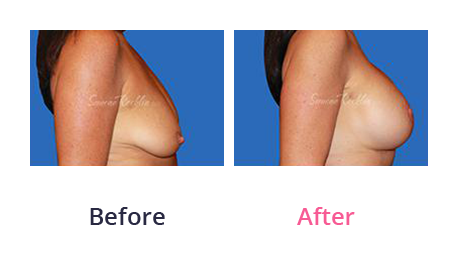 Mommy Makeover img (10)