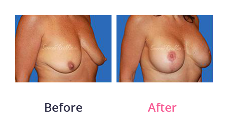 Mommy Makeover img (11)