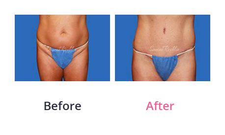 Mommy Makeover img (12)