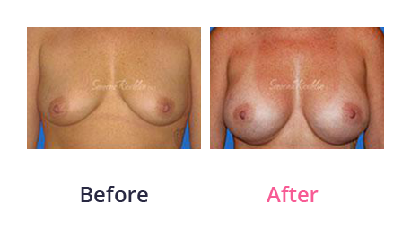 Mommy Makeover img (16)