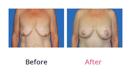 Mommy Makeover img (17)