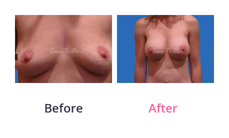Mommy Makeover img (18)