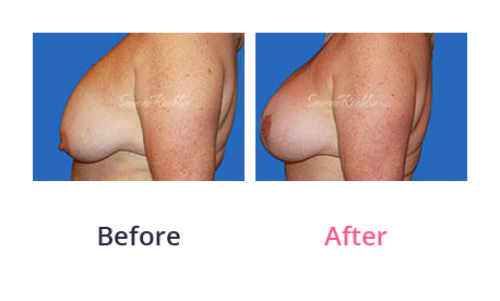 Mommy Makeover img (2)