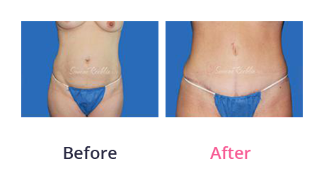 Mommy Makeover img (20)