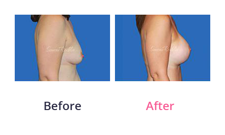 Mommy Makeover img (21)