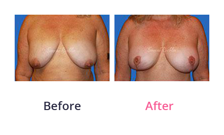 Mommy Makeover img (22)