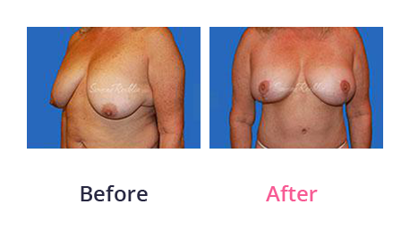 Mommy Makeover img (23)