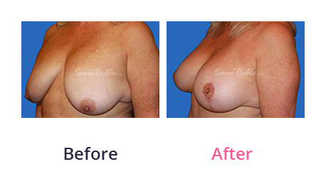 Mommy Makeover img (24)
