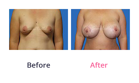 Mommy Makeover img (25)