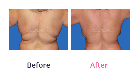 Mommy Makeover img (27)