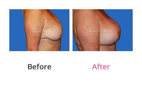 Mommy Makeover img (3)