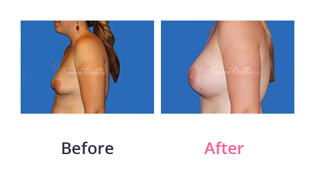 Mommy Makeover img (34)