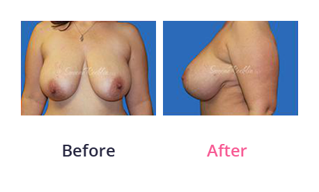 Mommy Makeover img (38)