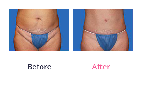Mommy Makeover img (4)