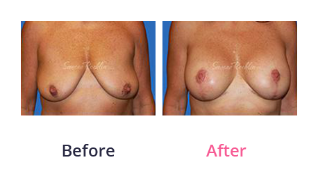 Mommy Makeover img (41)