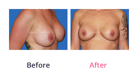 Mommy Makeover img (42)