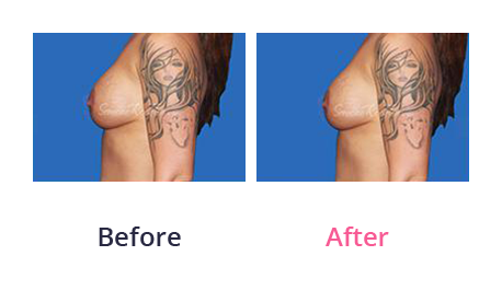 Mommy Makeover img (45)