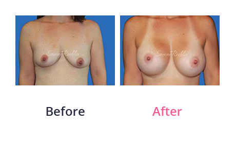 Mommy Makeover img (48)