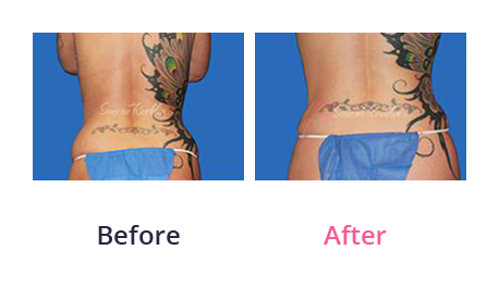 Mommy Makeover img (49)