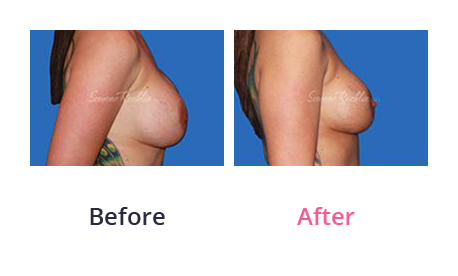 Mommy Makeover img (50)