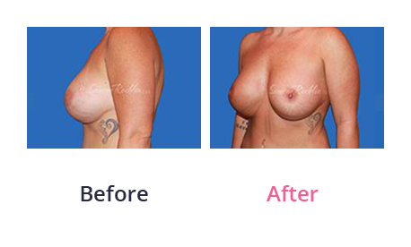 Mommy Makeover img (54)