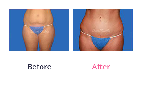 Mommy Makeover img (56)