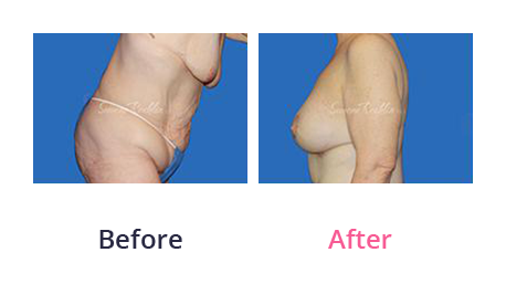 Mommy Makeover img (68)