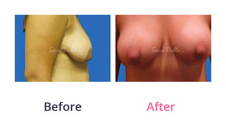 Mommy Makeover img (70)