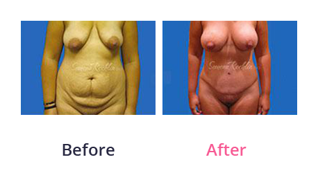 Mommy Makeover img (72)