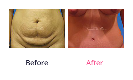 Mommy Makeover img (73)